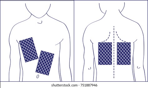 Back and chest with a mustard leaf. Retro picture. Sketch. 