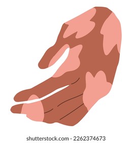 Back of the hand, brown skin with vitiligo patch