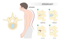 Back And Neck Pain Hunched Bone Posture With Kyphoplasty Spine Of Dowager’s Hump Disease Disk Joint Surgical Degeneration Over Backbone Vertebral Column