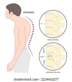 back and neck pain hunched bone posture with kyphoplasty spine of dowager’s hump disease disk joint surgical degeneration over backbone vertebral column