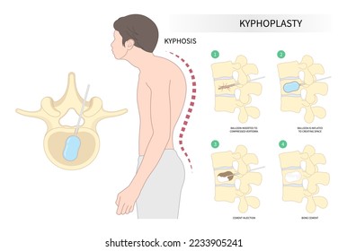 back and neck pain hunched bone posture with kyphoplasty spine of dowager’s hump disease disk joint surgical degeneration over backbone vertebral column