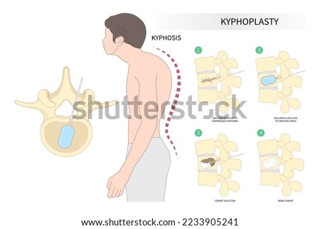 back and neck pain hunched bone posture with kyphoplasty spine of dowager’s hump disease disk joint surgical degeneration over backbone vertebral column