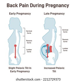 Dolor de espalda durante el embarazo. Mujer embarazada que experimenta una presión extrema sobre el cordón. Tensión en las articulaciones de la parte inferior de la espalda y de la pelvis. Ilustración vectorial plana