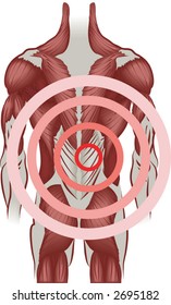 Back pain Muscles of the back radiating pain. No meshes used.