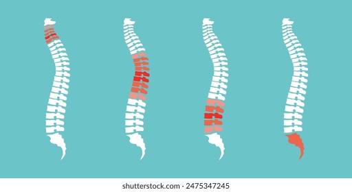 Juego de dolor de espalda. Oseocondrosis, hernia. Disco dorsal dañado. Cuatro divisiones de la columna. Secciones cervicales, torácicas, lumbares y sacras de la columna. Vector