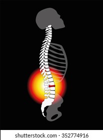 Back pain - spinal disc herniation or prolapse at a human vertebral column - profile view. Vector illustration on black background.