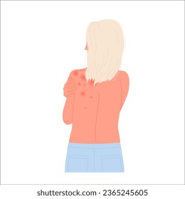 Back view of girl with body allergy. Allergic itchy reaction, atopic dermatitis flat vector illustration