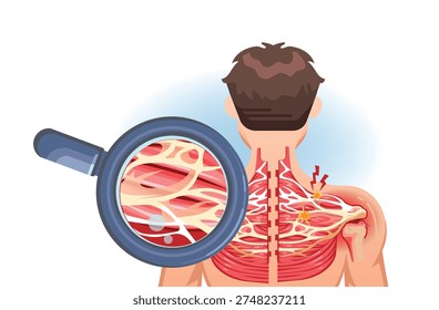 Back view illustration showing shoulder fascia adhesion causing muscle inflammation and radiating pain.