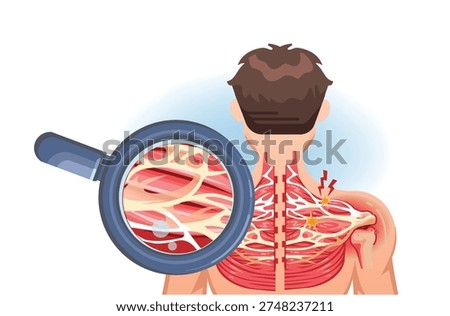 Back view illustration showing shoulder fascia adhesion causing muscle inflammation and radiating pain.