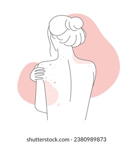 Back view of woman body with allergic skin reaction. Female body covered with red rash line vector illustration