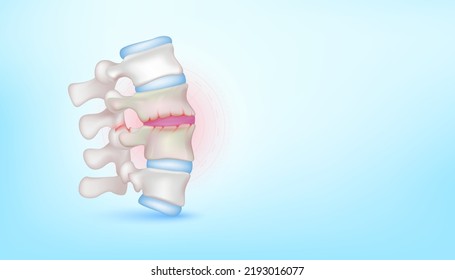 Backbone disc joint degeneration herniation cartilage on blue background with copy space for text. ฺBone human skeleton anatomy of the body. Medical health care science concept. Realistic 3D Vector.