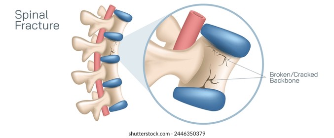 Backbone spinal cord compression fracture. Vertebra and compression or stress in the spinal cord. A type of broken bone that can cause your vertebrae to collapse, making them shorter.