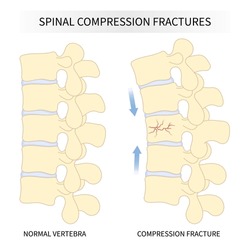 Backbone Vertebral Column Joint Disease With Kyphoplasty Spine Of Dowager’s Hump Posture Hunched Back Over Bone Disk Neck Pain Surgical Degeneration