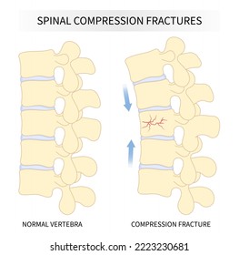 backbone vertebral column joint disease with kyphoplasty spine of dowager’s hump posture hunched back over bone disk neck pain surgical degeneration