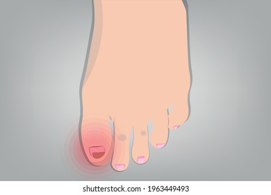 Background of Close up Cracked nails, Foot , isolated on gray background. Healthcare and Medical concept