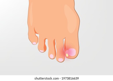 Background of Close up Ingrown toenail