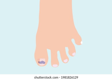 Background of Close up Nail rot