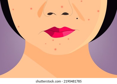Background of Close up Woman that full of zits on her face at the mirror with a purple background. Healthcare and Medical concept