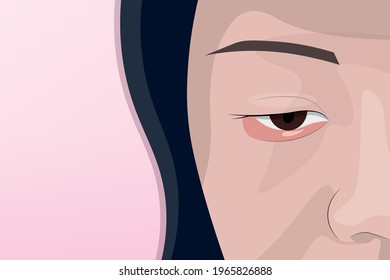 Background of Close up young caucasian brunette woman barley brown eye infection, eyelid abscess, style, hordeolum, isolated on light pink background. Healthcare and medical concept