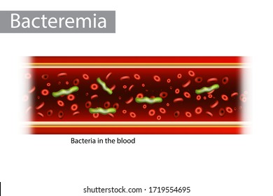 Bacteremia (also Bacteraemia) Is The Presence Of Bacteria In The Blood.