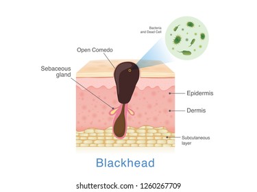 Bacteria in blackhead with human skin layer structure. Illustration about Acne from clogged in pore.