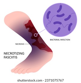 Bacteria infection on the skin cancer with Necrotizing fasciitis of leg cause limb pain fat scab in medical care