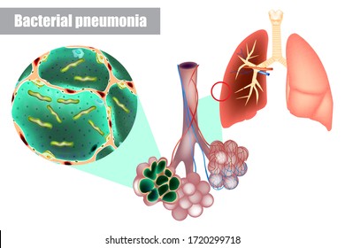 Bacterias dentro de los alveolos del pulmón. Neumonía bacteriana (infección bacteriana). La enfermedad neumocócica, que causa Streptococcus pneumoniae, es una causa importante de neumonía bacteriana.