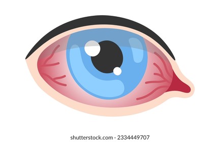 Bacterial Conjunctivitis Eye Disease Vector Illustration