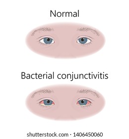 Bacterial conjunctivitis. Infection. Comparison with normal. Vector flat medical illustration.