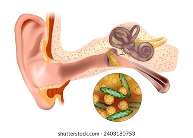 Bacterial ear infection. Ear infection (middle ear). Streptococcus pneumoniae and Haemophilus influenzae