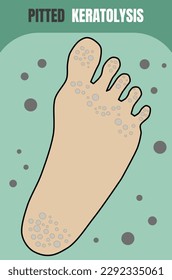 Bacterial infection the skin on feet that like pits and malodour