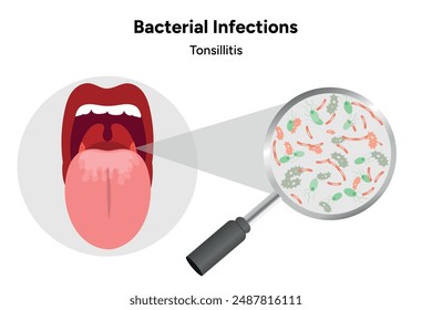 Bacterial infections tonsillitis, open mouth with zoom bacterials