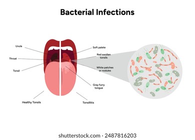 Bacterial infections tonsillitis, open mouth with zoom bacterials medical diagram 