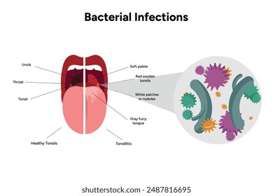 Bacterial infections tonsillitis, open mouth with bacterials medical diagram  