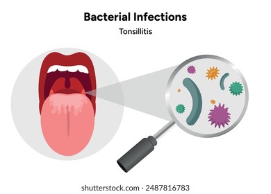 Infecciones bacterianas amigdalitis, boca abierta con efecto zoom bacterias