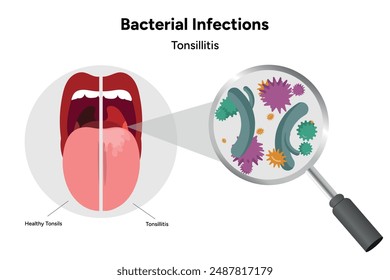 Bacterial infections tonsillitis, open mouth with zoom bacterials and healthy tonsils 