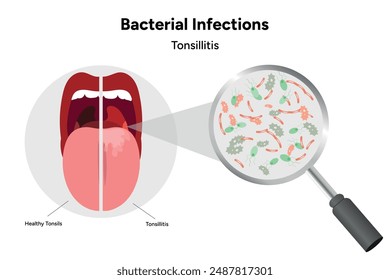 Bacterial infections tonsillitis, open mouth with bacterials and heathy side tonsils 