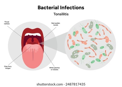 Bacterial infections tonsillitis, open mouth with zoom bacterials medical illustration 