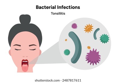 Bacterial infections tonsillitis, open mouth with zoom bacterials, medicine
