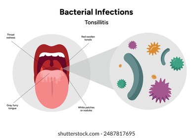 Bacterial infections tonsillitis, open mouth with zoom bacterials on tonsils 