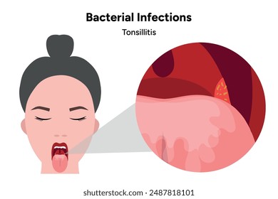 Bacterial infections tonsillitis, open mouth with zoom effect