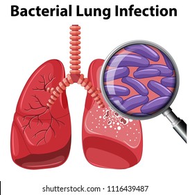 A Bacterial Lung Infection On White Background Illustration