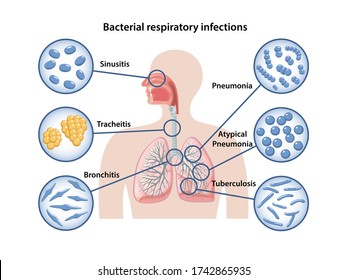 234 Mycoplasma pneumonia Images, Stock Photos & Vectors | Shutterstock