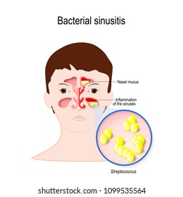 Sinusitis acute Acute Sinusitis: