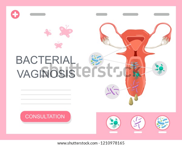 Bacterial Vaginosis Medical Infographics Female Reproductive Stock Vector Royalty Free 8149