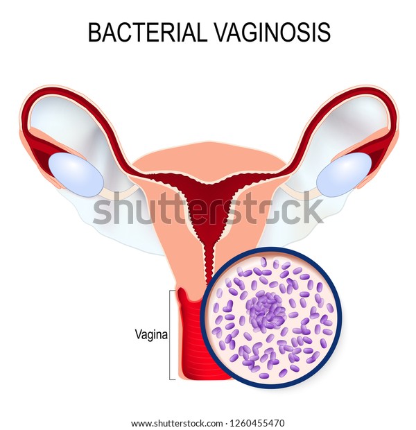 Bacterial Vaginosis Uterus Closeup Gardnerella Vaginalis Stock Vector Royalty Free