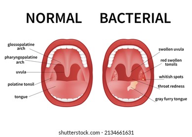 Bacterial and viral tonsillitis. Angina, pharyngitis, and tonsillitis. Tonsil infection. Open Mouth