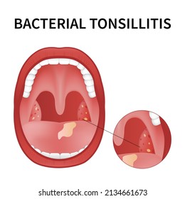 Vektor Stok Bacterial Viral Tonsillitis Angina Pharyngitis Tonsillitis ...