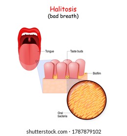 Bad Breath And Bacteria That Cause Halitosis. Human Mouth And Close Up Of Tongue. Magnification Of Taste Buds On The Tongue. Oral Bacteria