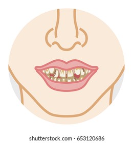 Bad dentition and dirty teeth